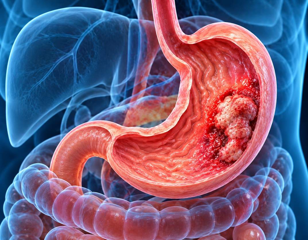 Stomach Cancer