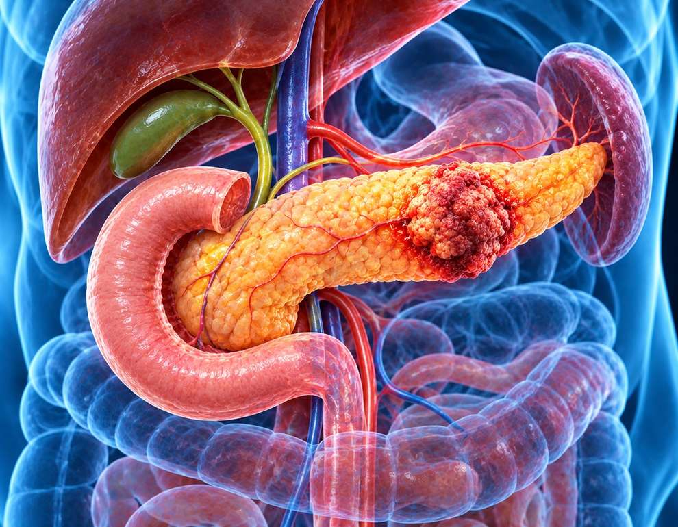 Pancreatic Cancer