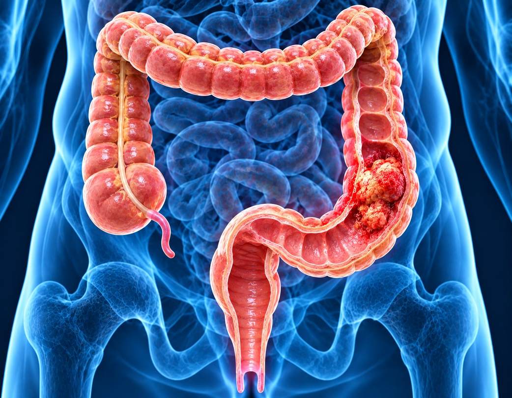Colorectal Cancer