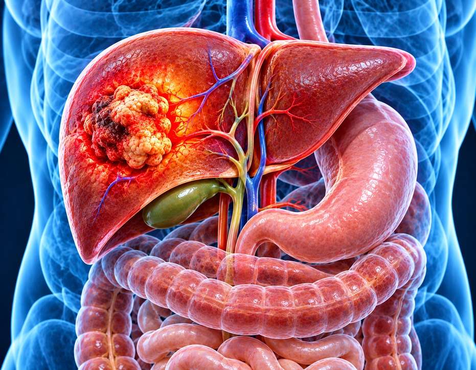 Liver Cancer